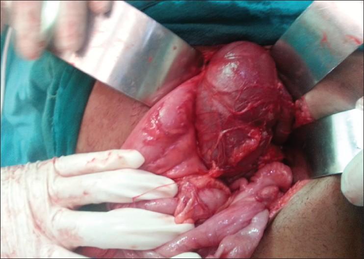 Figure 2: Intraoperative picture showing a tubular fluid-filled structure displacing the bowel loops