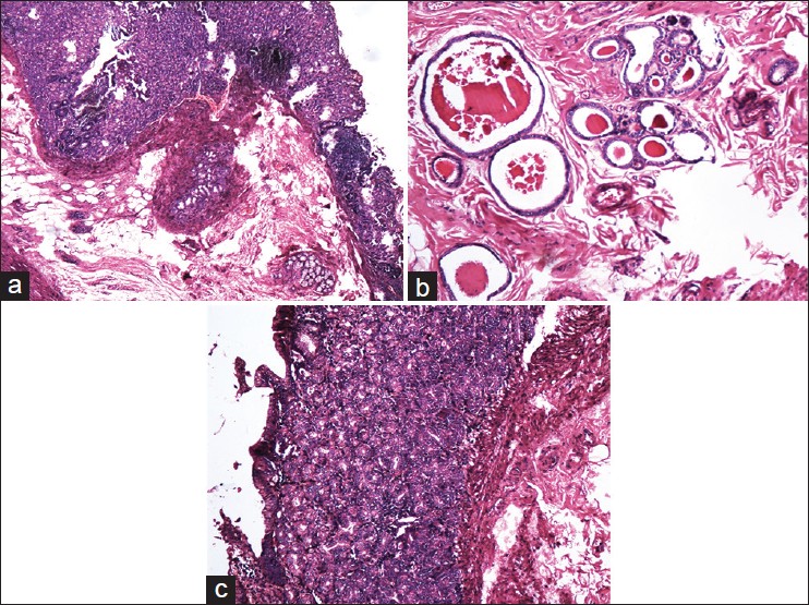 Figure 3: Histopathological image showing (a) gastric mucosa, (b) ectopic gastrointestinal gland and (c) ectopic pancreatic epithelium