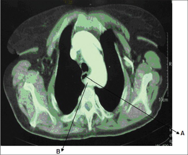Figure 1: Computed tomography scan of aberrant right subclavian artery (B) posterior to esophagus (A)