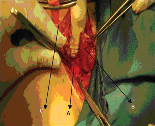 Figure 3: Intraoperative view, (A) aberrant subclavian artery; (B) the stump of Esophagus; (C) nelaton catheter in posterior mediastinum after removal of esophagus