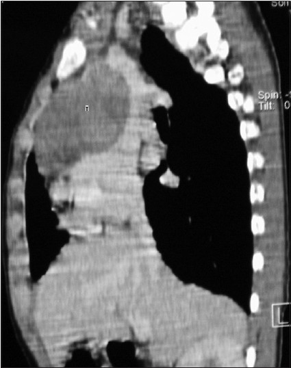 Figure 1: Computed tomography chest showing a large, lobulated, homogenous soft tissue anterior mediastinal mass (marked T). Fat planes with the superior vena cava, brachiocephalic vein and pericardium are maintained