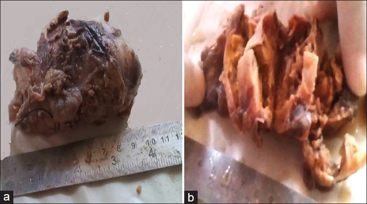Figure 2: Gross images show (a) A well-circumscribed mass with intact capsule (b) cut-surface shows cystic change with extensive necrosis