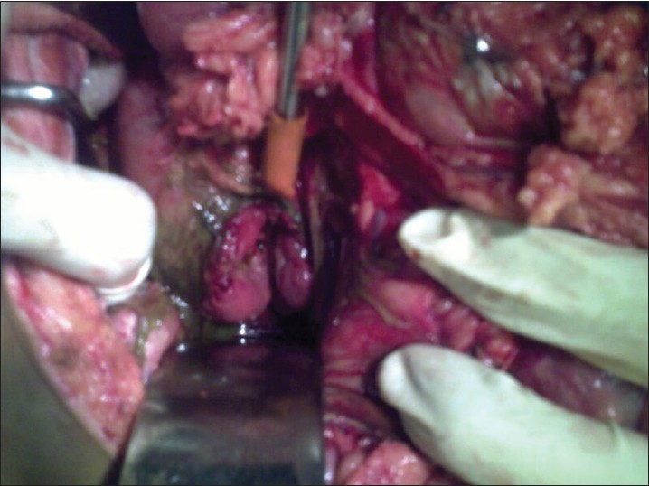 Figure 1: Duodenal transection