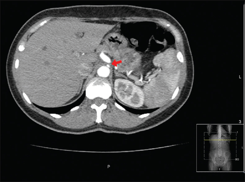 Figure 1: Computerized tomography showed a short stenotic segment at coeliac trunk with poststenotic dilatation