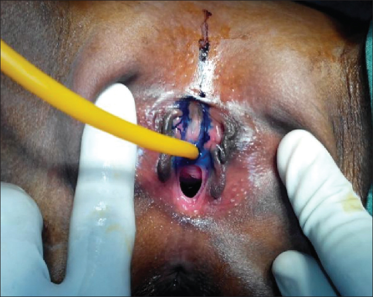 Figure 1: Parallel incision taken for reconstruction of urethra. Note the bifid clitoris with deficient dorsal wall