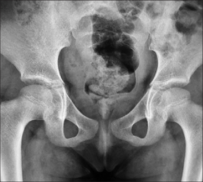 Figure 2: X-ray pelvis shows defect in the symphysis pubis