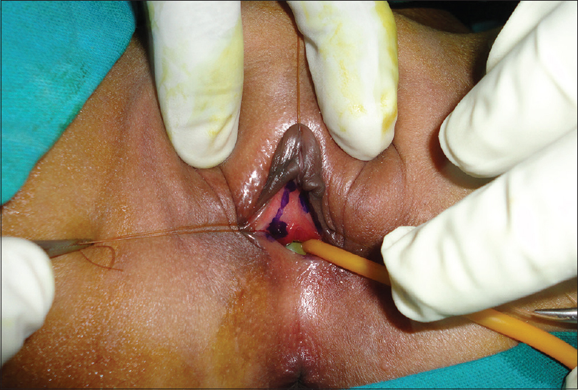 Figure 3: Female hypospadias; inverted U incision is taken for reconstruction of urethra. Note: that the bulb of the catheter is visualized suggestive of short urethra
