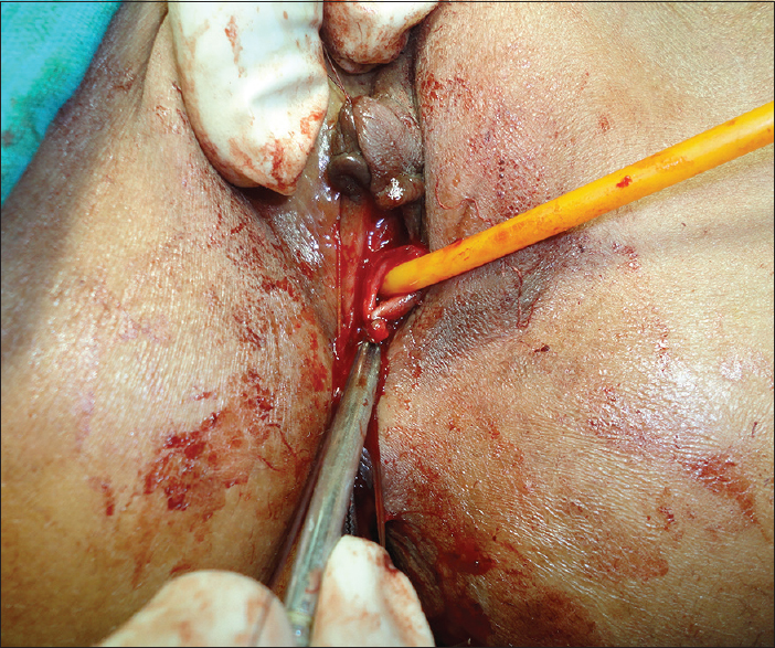 Figure 4: Urethra being reconstructed over a 12 French Foley's catheter