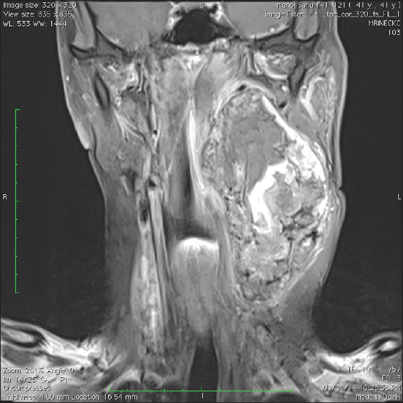 Figure 1: Contrast-enhanced magnetic resonance imaging, T1-weighted fat saturated coronal image shows a large isointense signal intensity mass admixed with hyperintense signal intensity