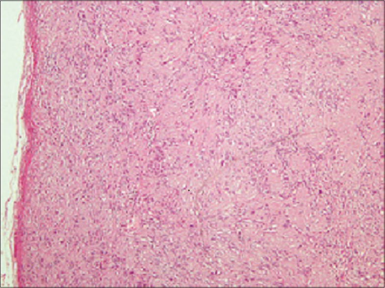 Figure 2: Section showing a well-encapsulated benign spindle cell tumor with characteristic Verocay bodies, consistent with schwannoma (H and E, ×5)