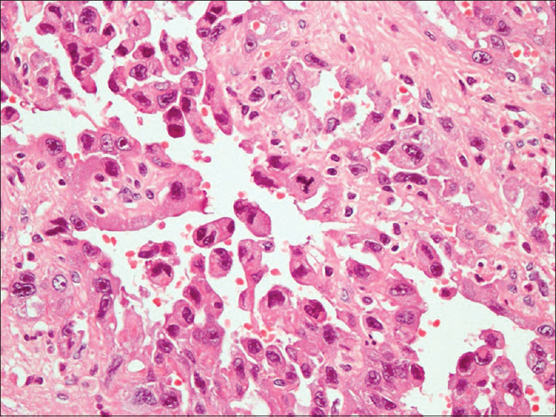 Figure 3: Immunohistochemistry - CD 31 - positive staining of atypical endothelial cells