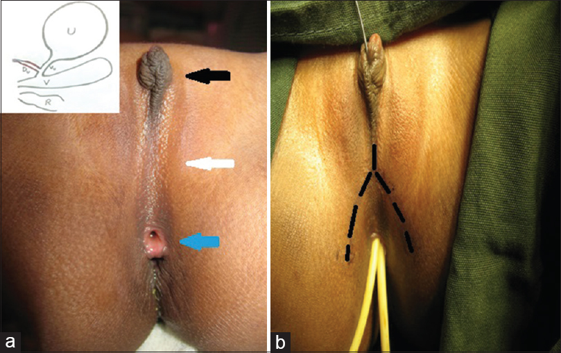 Figure 1: (a) Hypertrophied clitoris (black arrow), flat perineum (white arrow), and vaginal orifice (blue arrow). (b) Black dotted mark represents incision. Inset showing preoperative anatomy. U: Urinary bladder, V: Vagina, R: Rectum, Du: Dorsal urethra (red color), Vu: ventral urethra