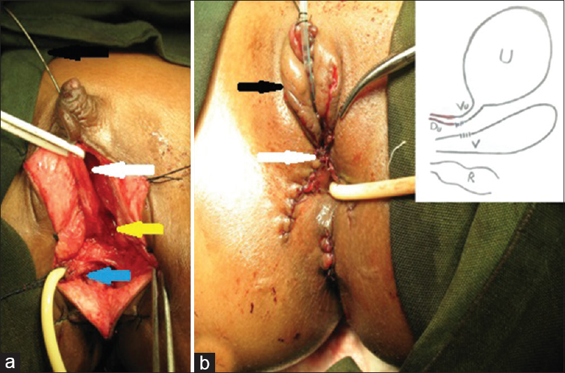 Figure 2: (a) Distal dorsal urethra (black arrow) and proximal dorsal urethra (white arrow). The vagina (blue arrow) and its confluence (yellow arrow) with the ventral urethra. (b) Feminizing genitoplasty (black arrow). Soft tissue interposition (white arrow) in between the repaired vagina and urethra. Inset showing postoperative anatomy