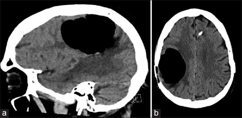 Figure 1: Sagittal (a) and axial (b) sections of computed tomography scan demonstrating pneumocephalus in the index patient