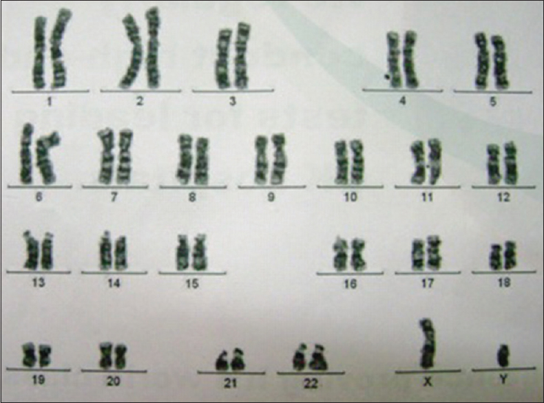 Figure 4: Patient's karyotype – normal male – 46 XY