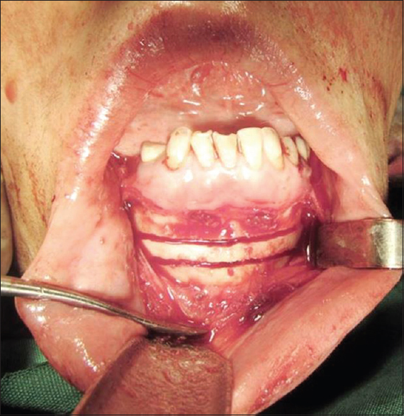 Figure 1: Wedge of the bone was harvested from anterior mandibular subapical osteotomy
