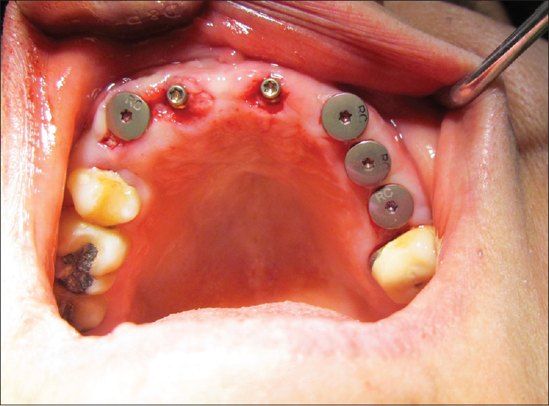 Figure 4: Healing caps in position on implant body and ideal gingival relationship