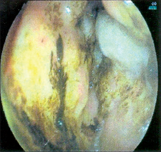 Figure 1: Endoscopy showing an ulcero-infiltrative growth in antrum extending onto the anterior wall of first part of duodenum