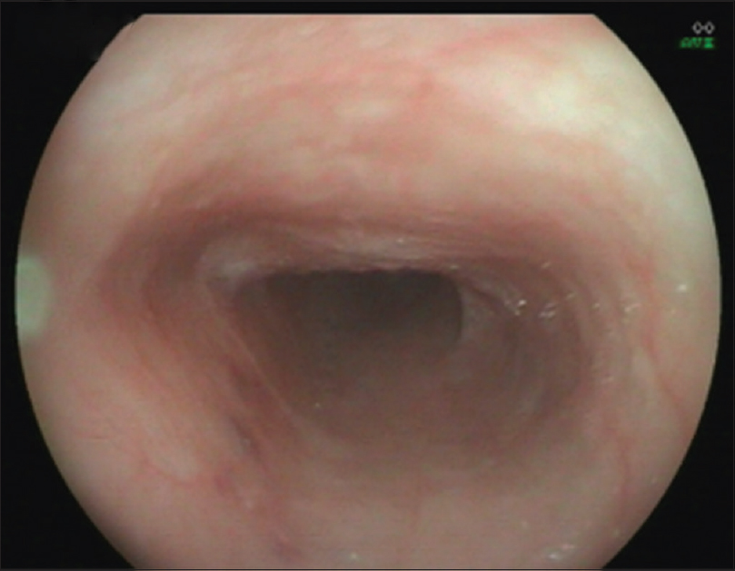 Figure 2: Endoscopy showing normal esophageal mucosa