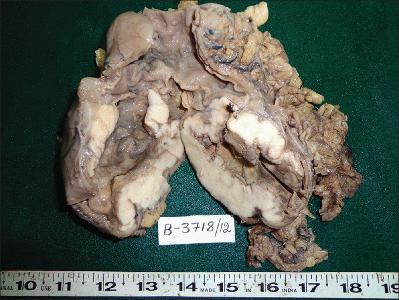 Figure 3: Distal gastrectomy specimen with an ulceroproliferative growth