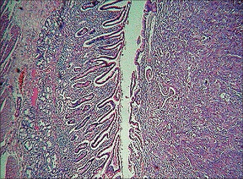 Figure 4: Neoplastic squamous cells islands in antrum and duodenum (H and E, ×4)