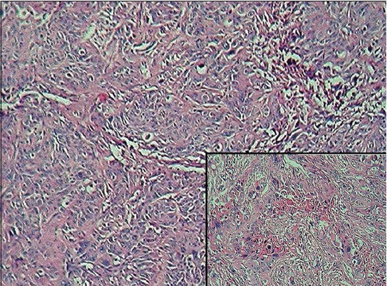 Figure 5: Neoplastic squamous cells islands with pleomorphism (H and E, ×10) inset: Areas of keratin formation