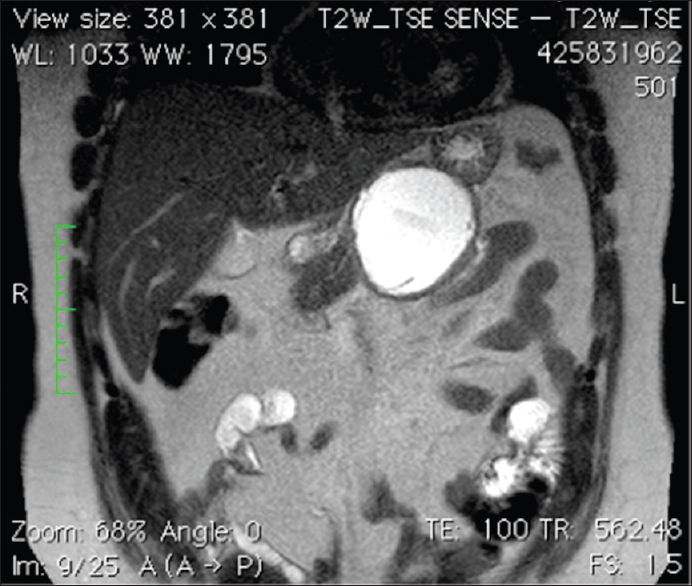 Figure 1: Coronal T2-weighted image of the pancreas showing a well-defined rounded cystic lesion abutting the ventral portion of the central pancreas. No daughter cysts could be seen indicating that the cyst is a Type CE 3 a (transitional hydatid cyst). The pancreatic duct is seen (as hyperintense line) leading to the lesion