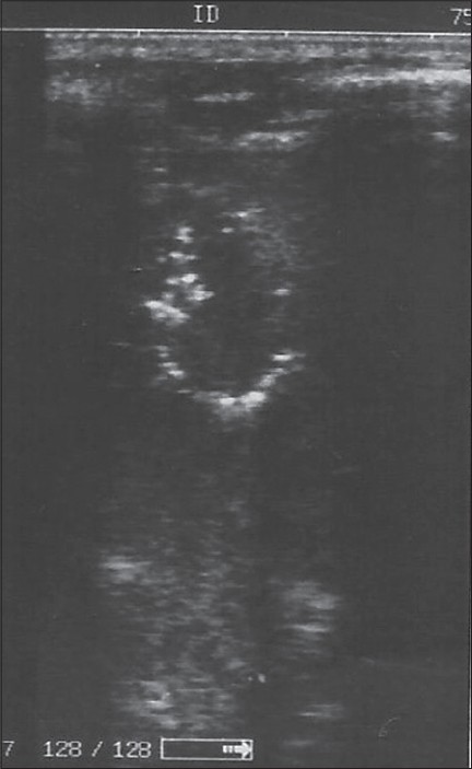 Figure 2: Sonogram of the liver with a drainage catheter, in a collapsed abscess cavity