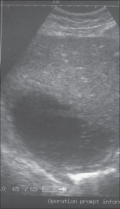 Figure 3: Sonogram of the liver showing a single abscess cavity in the right lobe