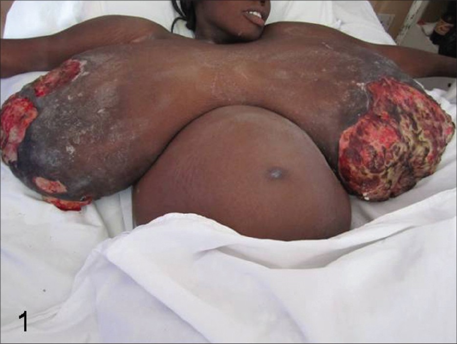 Figure 1: A 27-year-old woman at 22 week gestation with massive breast hypertrophy and extensive septic ulceration