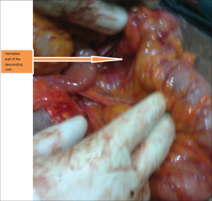 Figure 1: Herniated wall of the descending colon