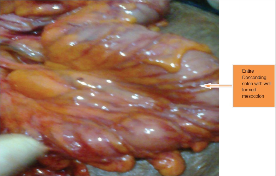 Figure 4: Entire mobility of the descending colon and showing
viability of the wall