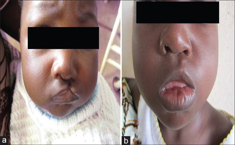 Figure 1: Incomplete left-sided cleft of the primary palate (a) Pre-operative (b) Post-operative