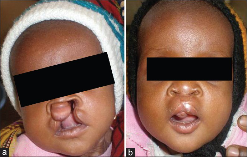 Figure 2: Complete bilateral cleft of the primary palate (a) Pre-operative (b) Post-operative