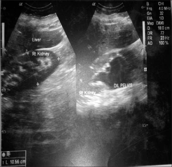 Figure 1: Abdominal ultrasound of a patient with pelvi-ureteric junction obstruction showing dilated right pelvicalyceal systems