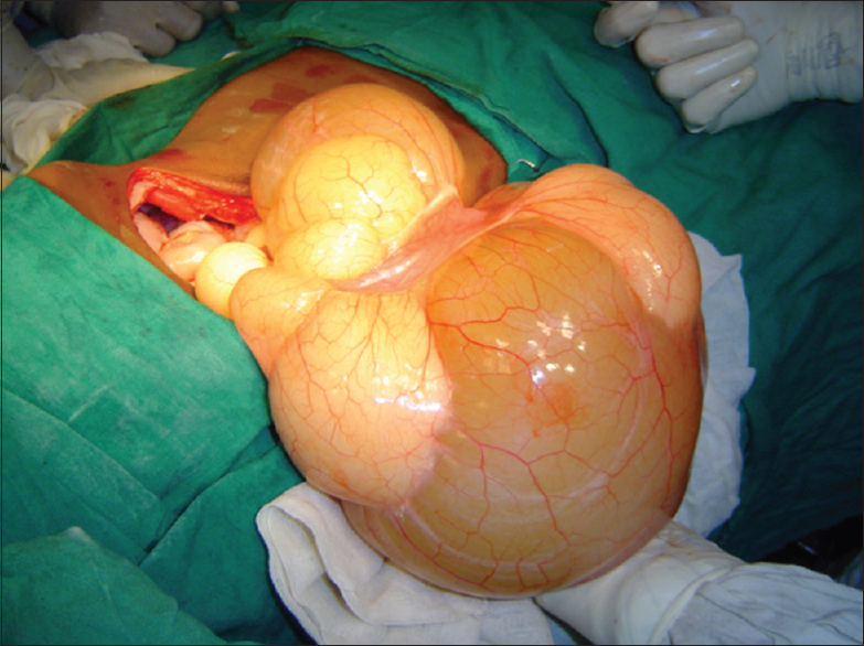 Figure 2: Large dumb-bell shaped mesenteric tumor with stretched out overlying jejunal segment