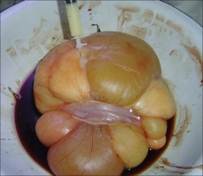 Figure 3: Excised specimen of the mesenteric tumor (lymphangioma) filled with milk cream thick chyle