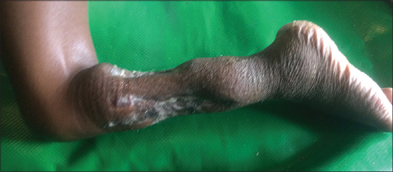 Figure 2: Deformed left leg, following fasciotomy and split skin grafting