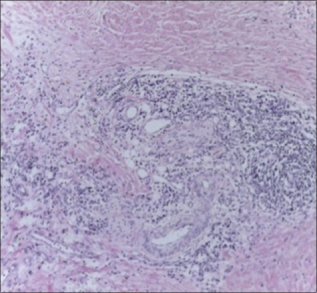 Figure 1: Numerous vascular channels lined by epithelioid endothelial cells (H and E, ×40)
