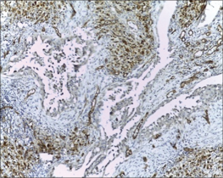 Figure 3: Positive immunohistochemical staining for CD34 antibody (IHC, ×40)