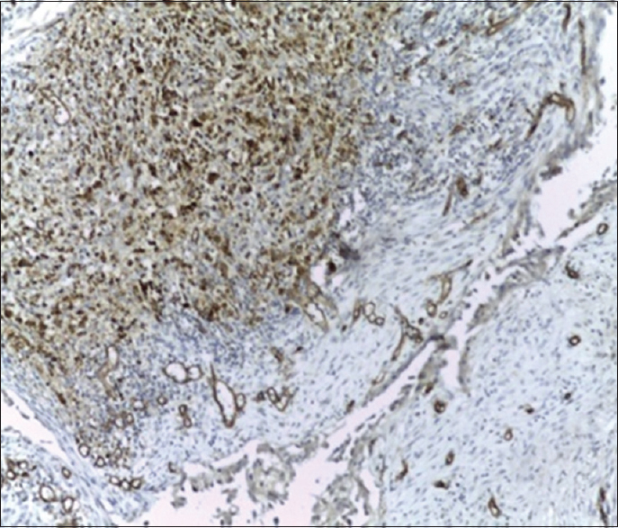 Figure 4: Positive immunohistochemical stain for CD 34 antibody (IHC, ×100)