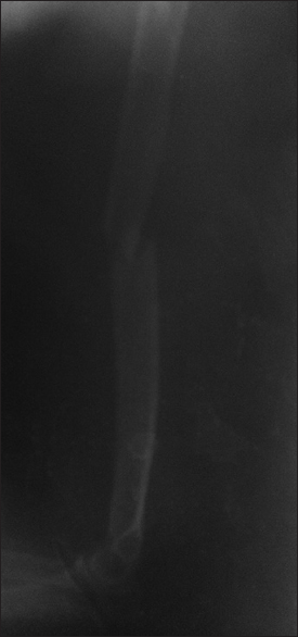 Figure 1: Plain radiograph showing minimally displaced fracture of the mid--shaft of the humerus, note even cortical thickening and no other evidence of bone lesion