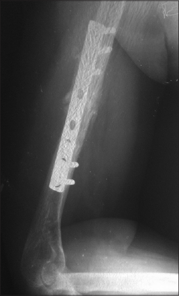 Figure 2: Plain radiograph showing union with hardware
