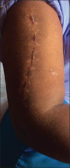 Figure 3: Nine weeks post operation, healed wound and clinical fracture union, return to activities of daily living