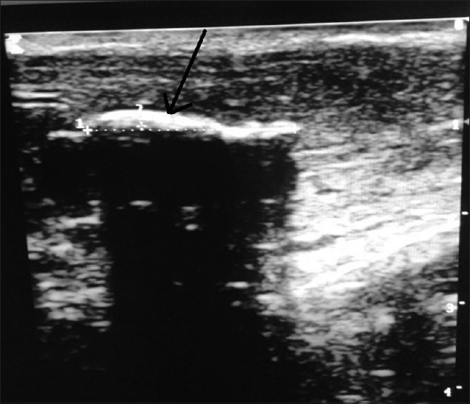 Figure 1: Longitudinal view; ultrasound scan of penile shaft