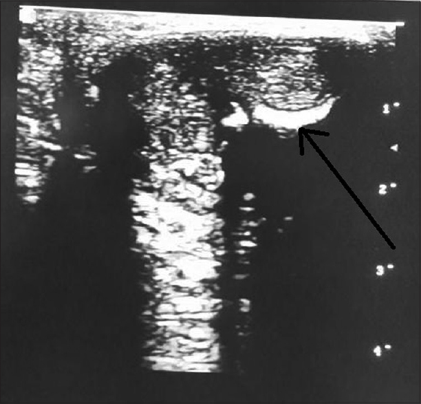 Figure 2: Transverse view; ultrasound scan of penile shaft