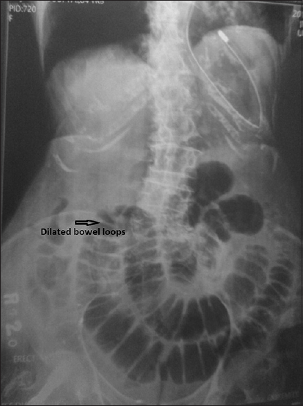 Figure 1: Plain X-ray showing dilated bowel loops