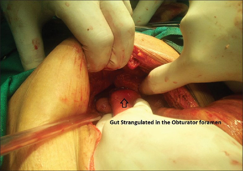 Figure 2: Gut entering into the obturator foramina