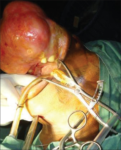 Figure 2: A medium-sized needle holder inserted through a submental incision (note that massive maxillary tumor)