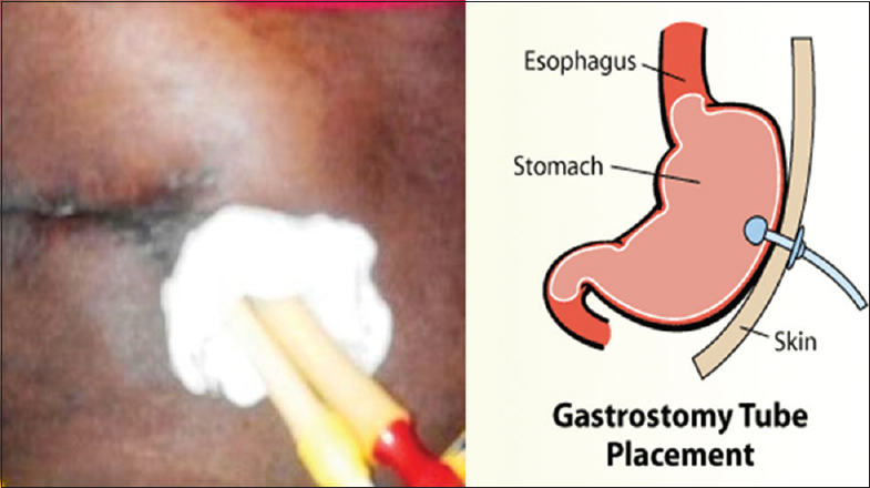Figure 2: Improvised gastrostomy tube (adjacent picture showing the mechanism of gastrostomy tube)